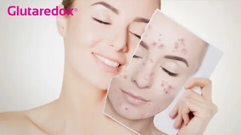 Acne removing