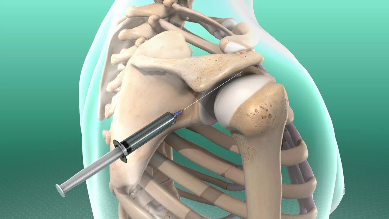 Операция на сустав бедра. Укол в плечевой Су тав .. Блокада плечевого сустава. Укол блокада в плечевой сустав. Внутрисуставная блокада плечевого сустава.