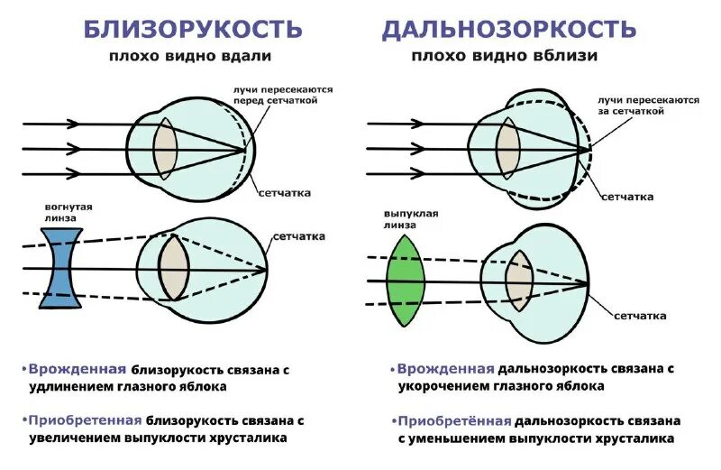 близорукость и дальнозоркость хрусталик. строение глаза lfkmyjpjhrjcnm b ,kbpjherh. заболевание 1) близорукость 2) дальнозоркость. ход лучей близорукость и дальнозоркость. коррекция пресбиопии при миопии.