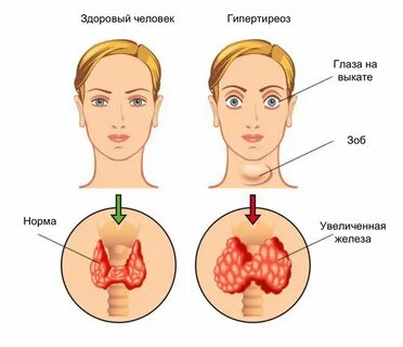 Заболевания щитовидной железы симптомы лечение (81 фото)