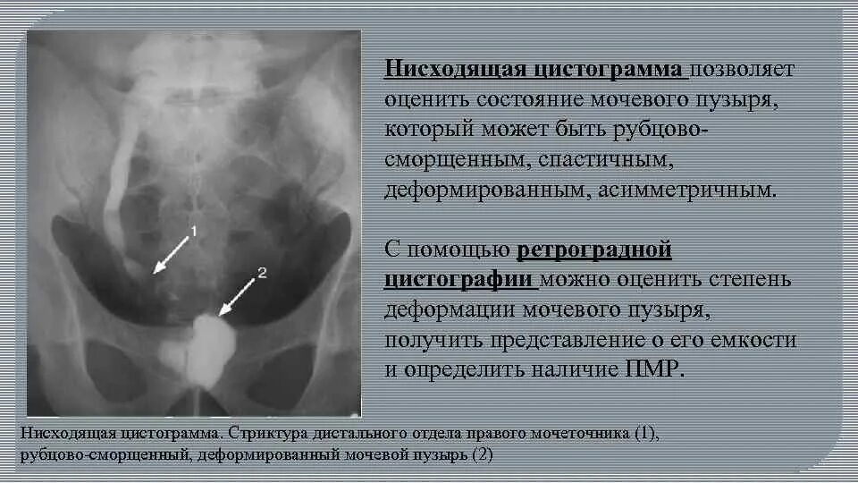 Мочеточник дистальный. Микционная цистография мочевого пузыря. Цистография мочевого пузыря рентген описание. Нисходящая цистография. Цистография нисходящая и восходящая.