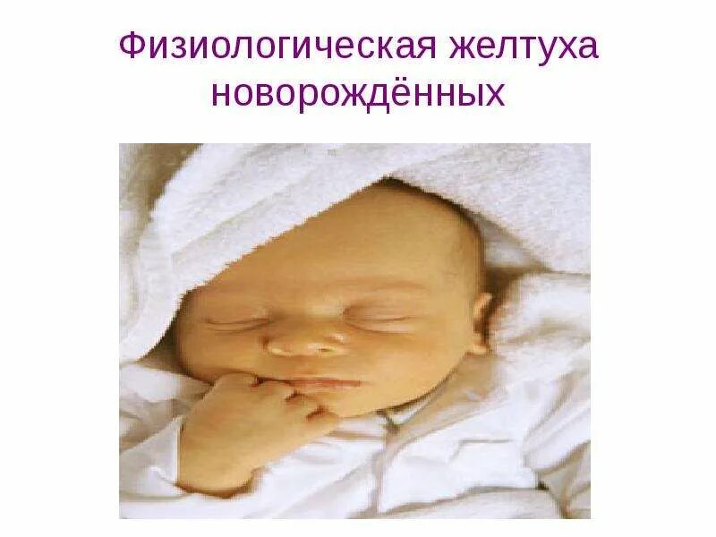 Эксхол от желтухи новорожденных. Физиологическая желтушка у младенцев. неонатальная желтуха новорожденных презентация. физиологическая желтуха новорожденного. физиологическая желтуха новорожденных презентация.