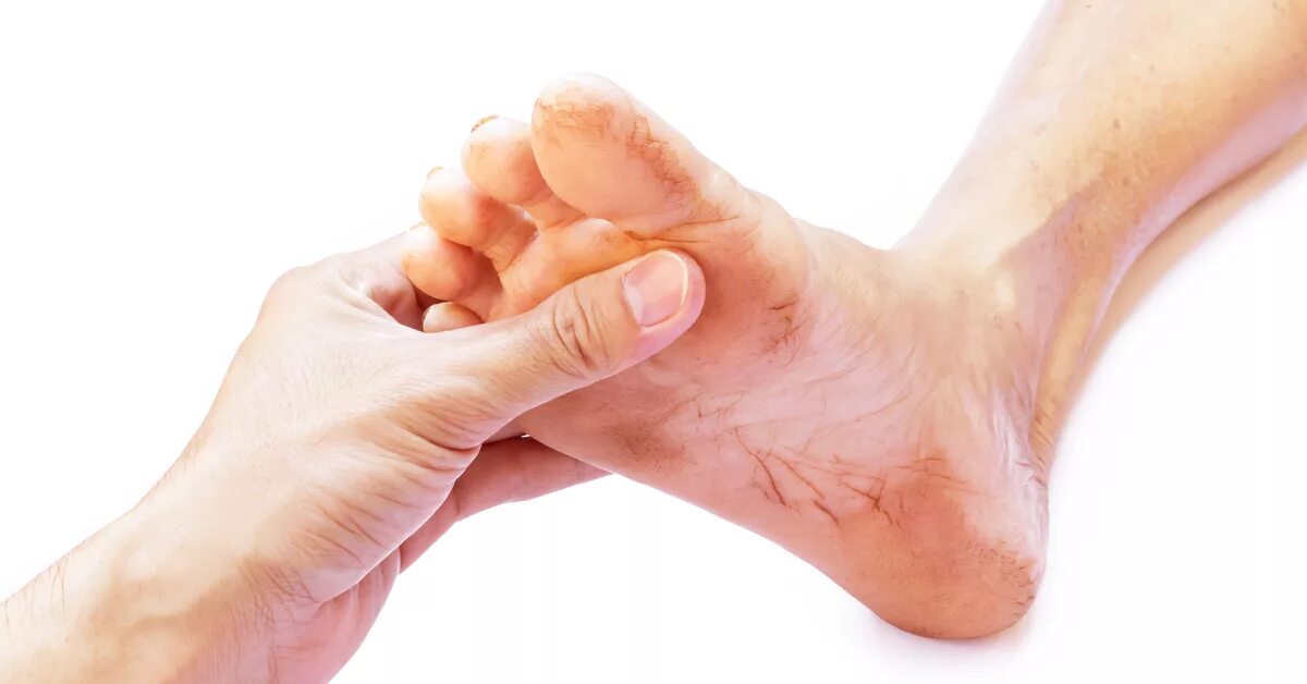 стопа при сахарном диабете. пятки при сахарном диабете 2 типа. стопы ног при сахарном диабете. диабетическая стопа язва. ноги больного сахарным диабетом.