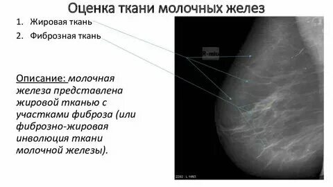 Что означает фиброзная ткань