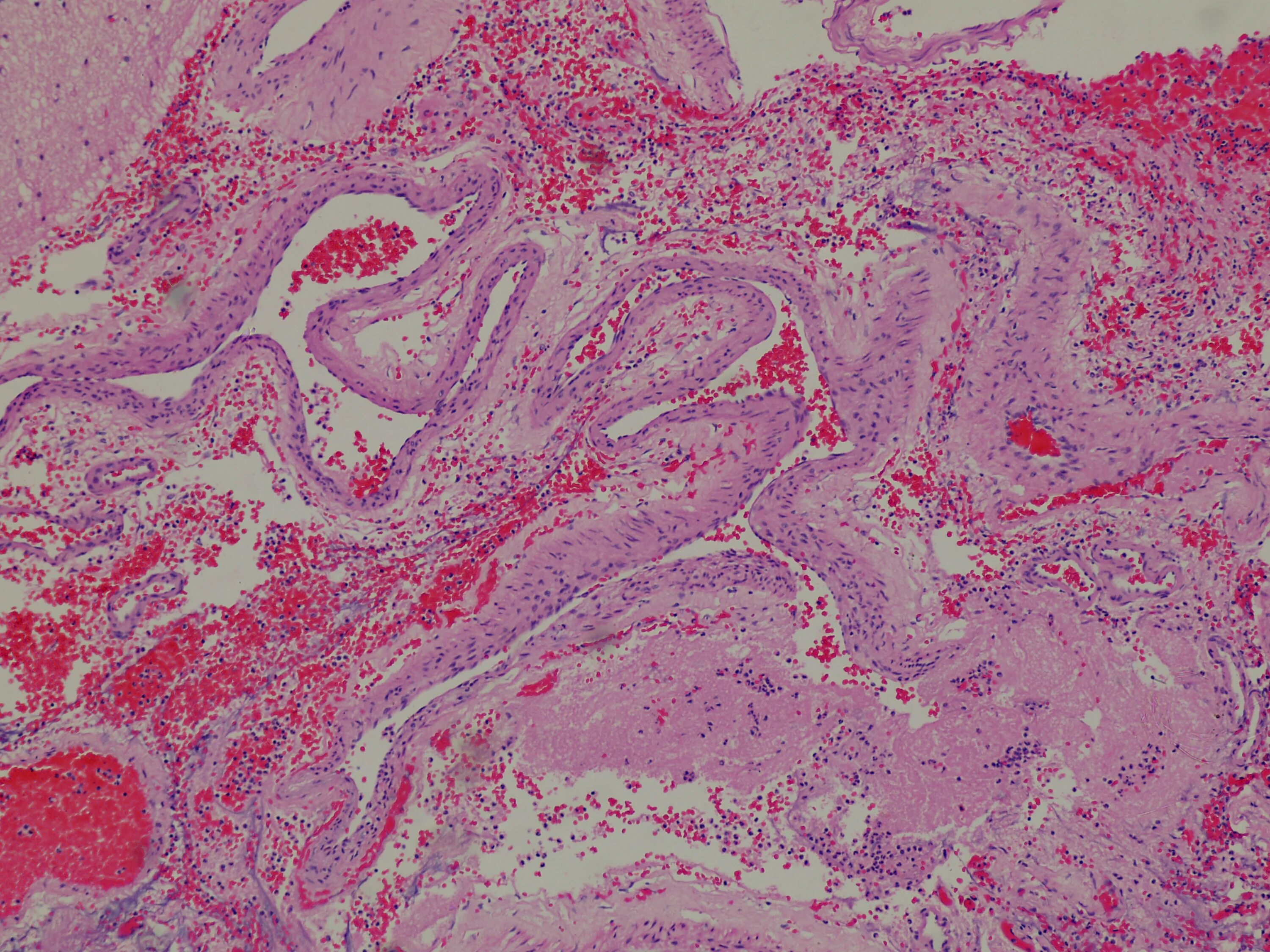 Микропрепарат головного мозга. Кавернозная гемангиома гистология. Гемангиома гистология патанатомия. Стаз сосудов патологическая анатомия. Мальформация патанатомия.