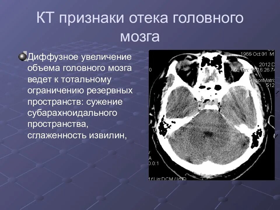 Травматический отек мозга. Вазогенный отек головного мозга кт. Отек головного мозга на кт признаки.