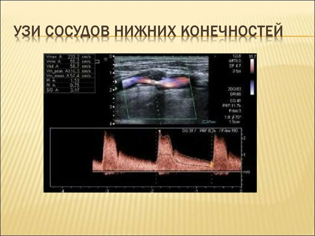 И сосудов нижних конечностей цена. УЗИ анатомия артерий нижних конечностей. УЗДГ сосудов нижних конечностей анатомия. УЗИ исследование сосудов нижних конечностей. Сосуды нижних конечностей анатомия УЗИ.