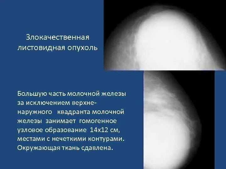 Опухоль в верхнем наружном квадранте молочной железы. В верхне наружном квадранте молочной железы. Квадранты молочной железы схема. Наружный квадрант молочной железы. Аденоз молочных желез на маммографии.