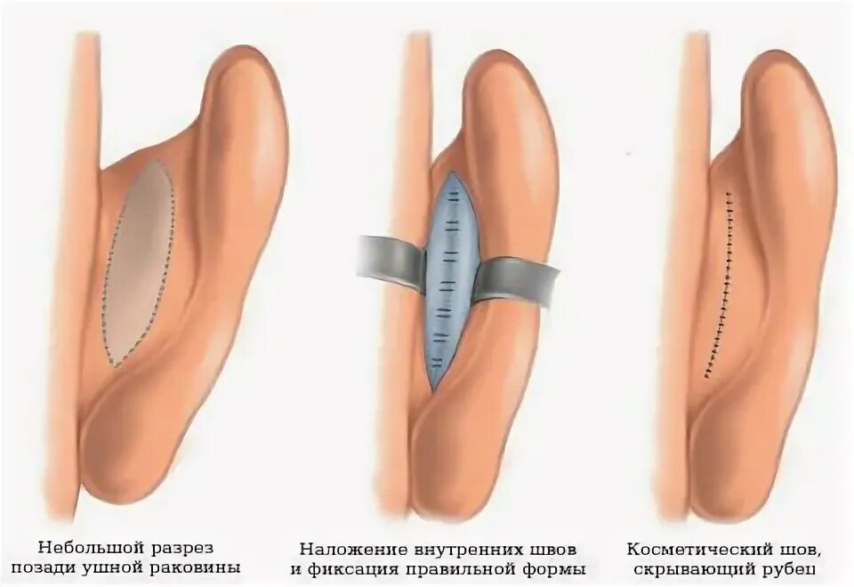 Как сделать чтобы уши не торчали