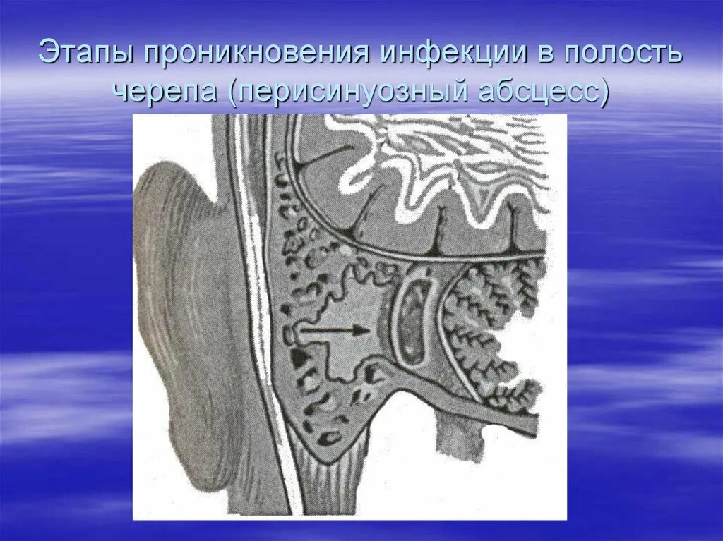При передневерхней локализации абсцесс формируется. Отогенный перисинуозный абсцесс. отогенный сепсис. отогенный лептоменингит. отогенный менингит.