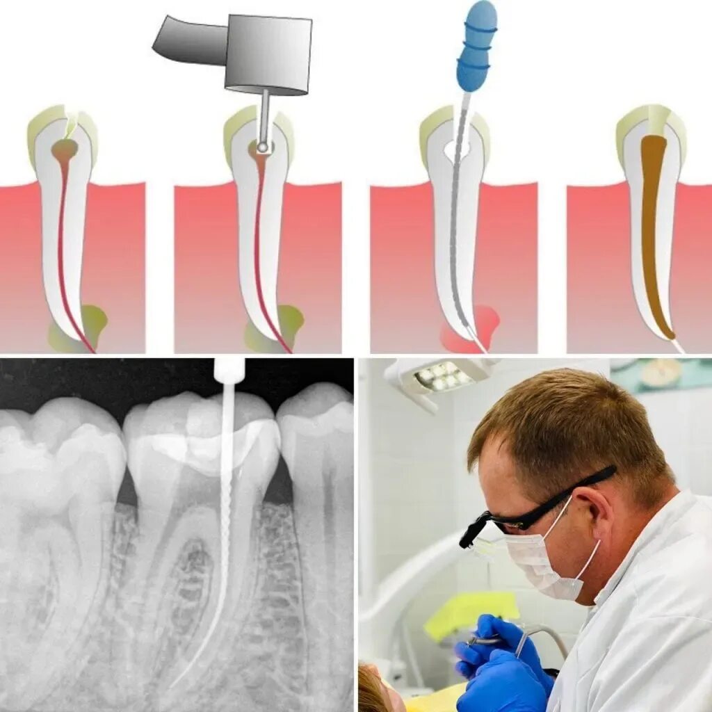 Пломбирование корневых каналов. Пломбирование канала зуба. Пломбирование каналов зубов.