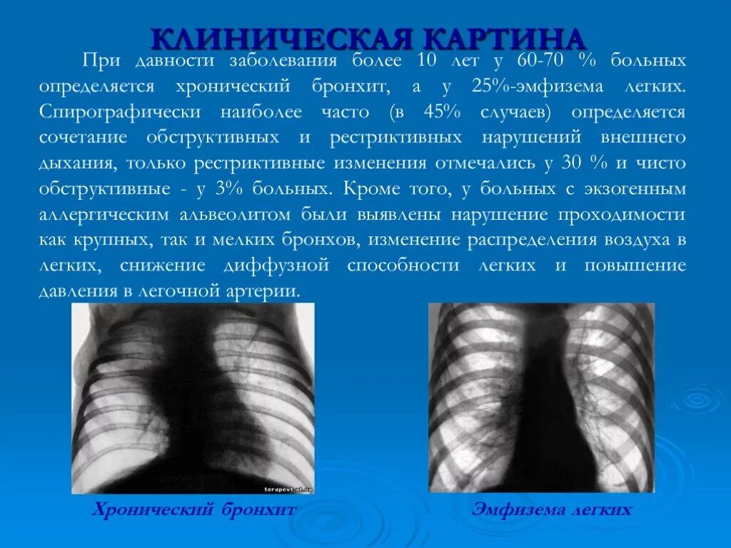 Аллергический альвеолит. Экзогенный аллергический альвеолит. Экзогенный аллергический альвеолит кт. Альвеолит презентация.