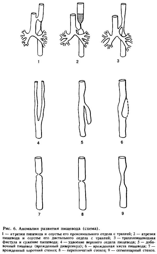 Формирование пищевода. Врожденные пороки развития пищевода классификация. Атрезия пищевода схема. Врожденные аномалии развития пищевода хирургия. Анатомические формы атрезии пищевода.