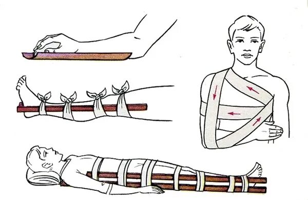 уложить повязка. повязка бинт десмургия. спиральная повязка на конечность. восьмиобразная или крестообразная повязка. бинты послеоперационные на ноги.