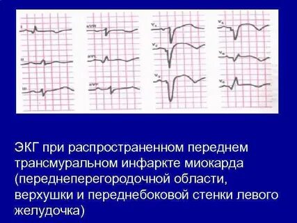 Трансмуральный экг