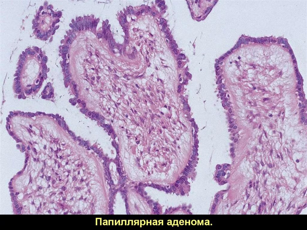 Тубулярная аденома толстой кишки гистология. Микрофолликулярная аденома щитовидной железы гистология. Атипичная аденома. Фолликулярная карцинома щитовидной железы гистология. Атипичная аденома.