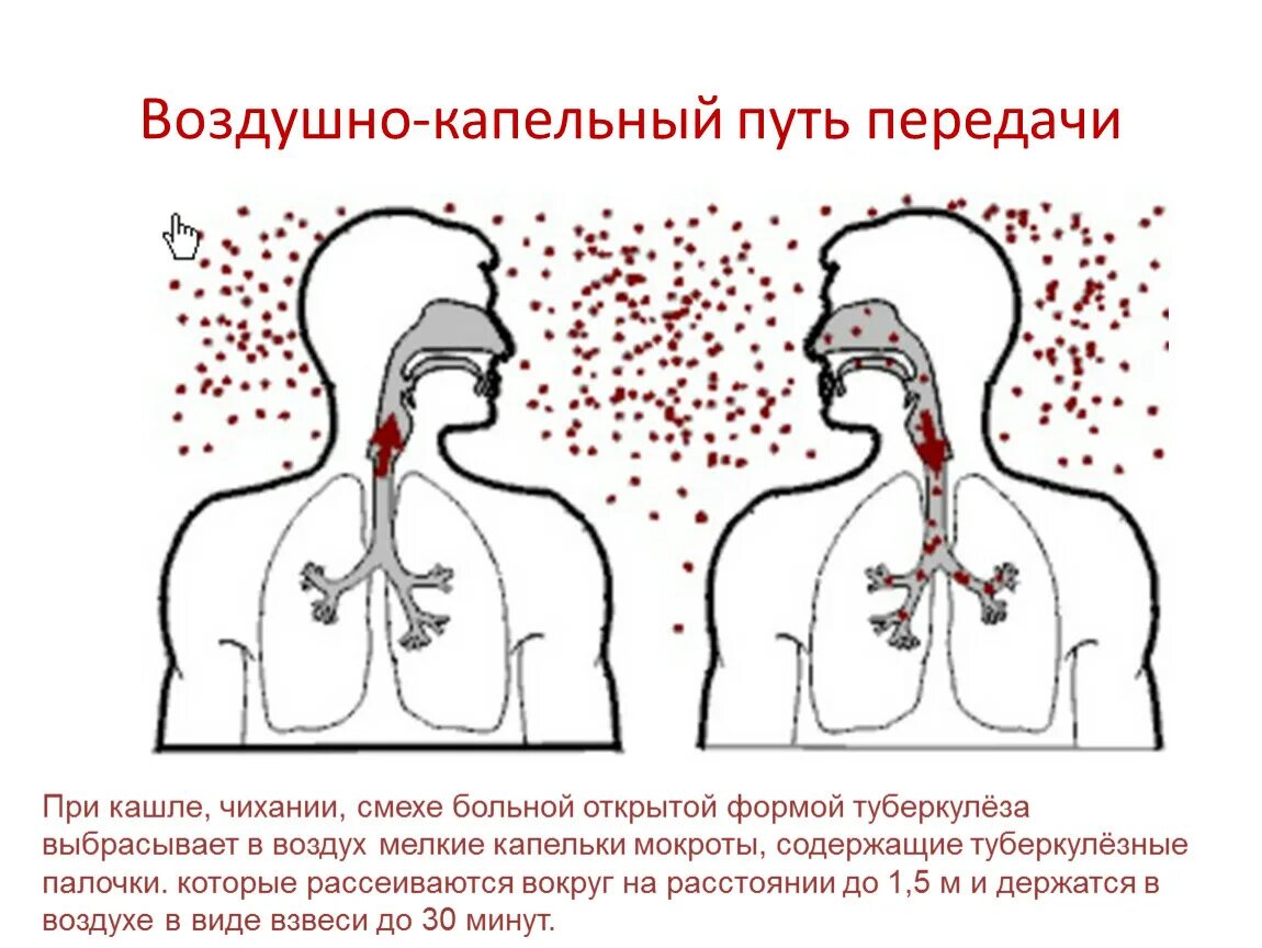 Легко передается воздушно капельным. Капельный путь передачи инфекции. Воздушно капельный путь заражения туберкулезом. Воздушно-капельный путь передачи кори. Воздушно пылевой путь передачи туберкулеза.