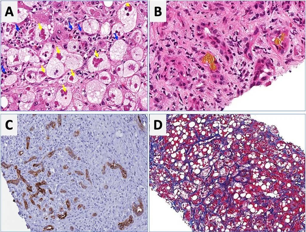 Алкогольный гепатит гистология. Жировой гепатоз печени гистология. Острый алкогольный гепатит микропрепарат. Цирроз печени гистология.
