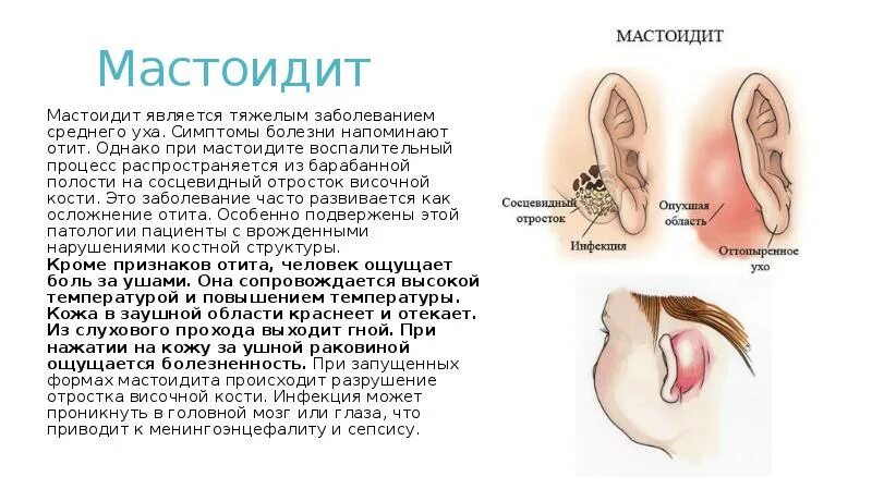 Mastoiditis Causes Symptoms Diagnosis Complications and Treatment