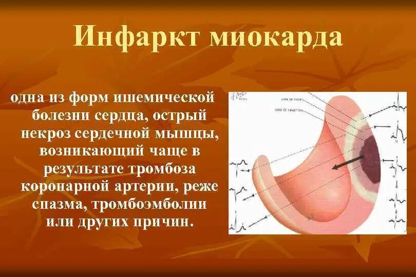 Осложнения хронической ишемической болезни сердца. Основные клинические проявления ибс. Ибс острый q инфаркт миокарда. Ибс: острый инфаркт миокарда осложнения. Острая ишемия миокарда.