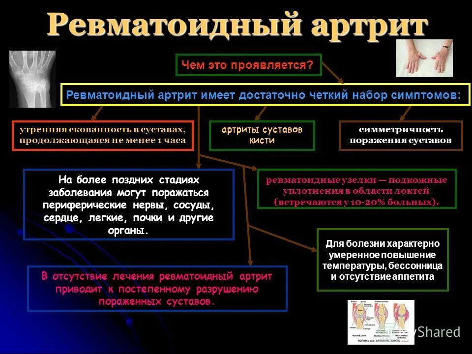 Скованность при ревматоидном артрите. Для ревматоидного артрита характерны:. Для ревматоидного артрита типичны. Для ревматоидного артрита характерно наличие. Презентация на тему ревматоидный артрит.