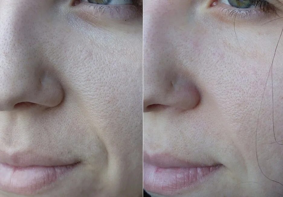 Поры на лице до и после Консилер лечебный Magic Minerals Hide and Heal Concealer Medium "Если вам есть