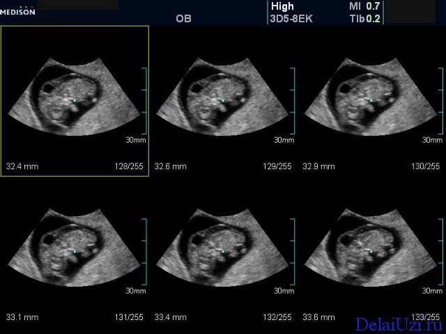 можно ли трансвагинальное узи при беременности. расшифровка трансвагинального узи. трансвагинальное узи заключение. трансвагинальное узи заключение. можно ли трансвагинальное узи при беременности.