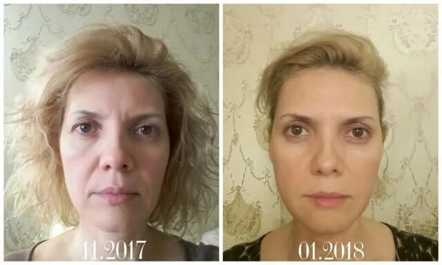 Фейсбилдинг для лица * отзывы с фото до и после упражнений, результаты