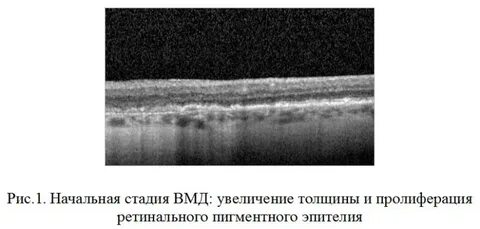 Увеличение толщины