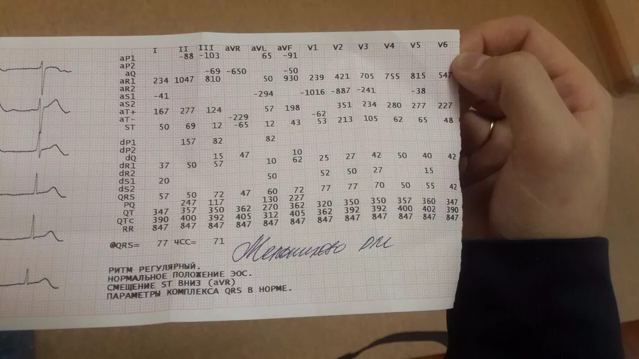 Смещение st вниз avr. Экг смещение st вниз avr,v1,v2. смещение st вверх на экг. v2-v3 на экг. экг v2 отклонения.