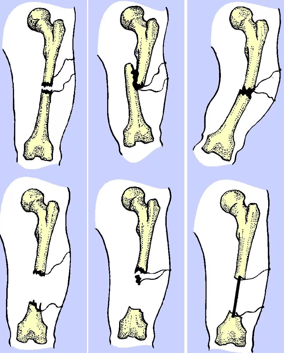 Эпифизарный остеомиелит. Метафизарный перелом голени. Эпифизарные переломы кости. Эпифизарный остеомиелит бедра.