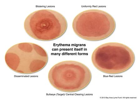 Eye Symptoms: Lyme Disease Eye Symptoms