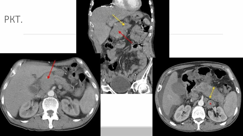 Рак поджелудочной прогнозы жизни. Карцинома поджелудочной железы кт. Протоковая карцинома поджелудочной железы кт. Панкреатическая аденокарцинома кт. Метастазы поджелудочной железы на кт.
