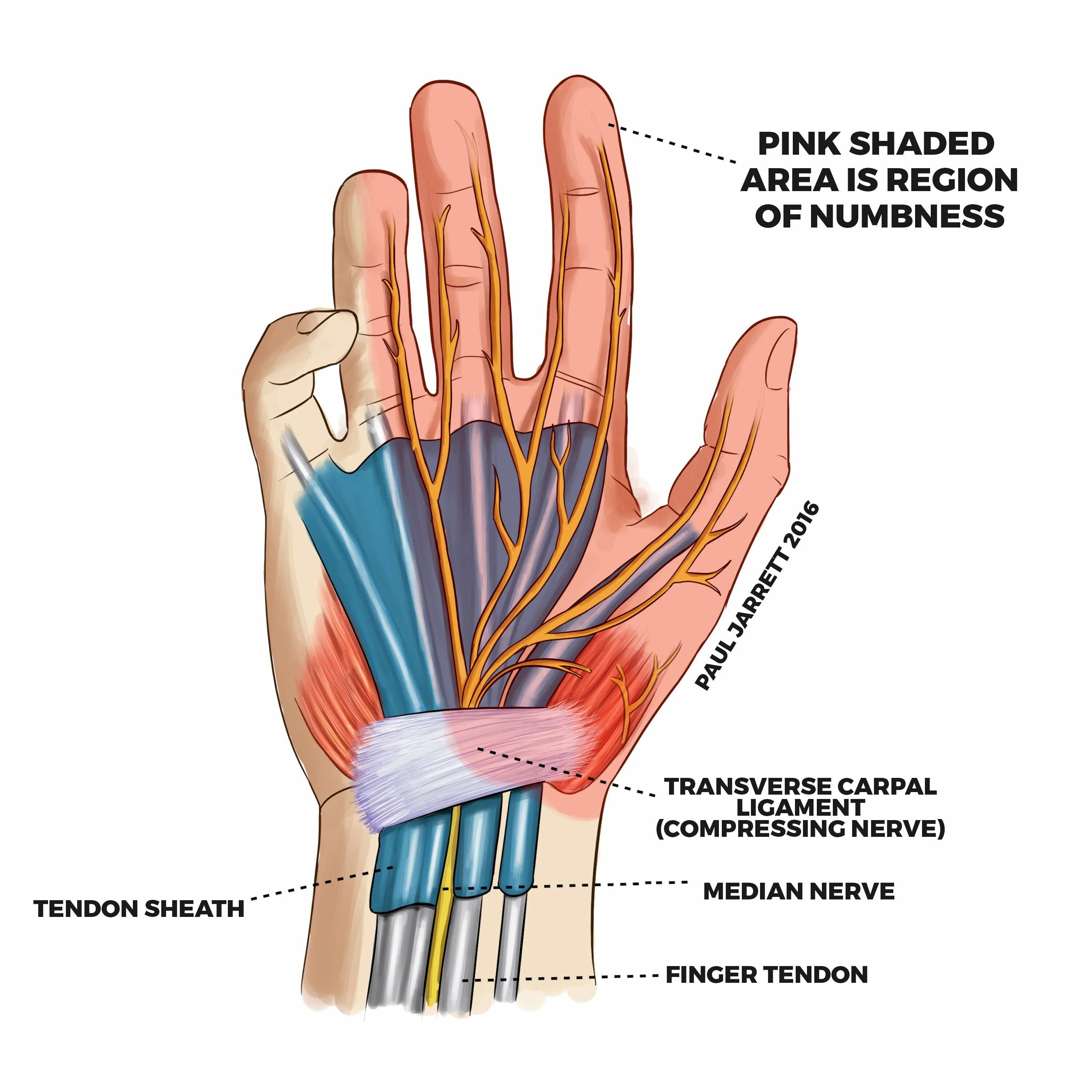 Анатомия срединного нерва на кисти. Синдром запястного канала запястье. Туннельный синдром запястья кисти фото. Туннельный синдром пальцев руки.