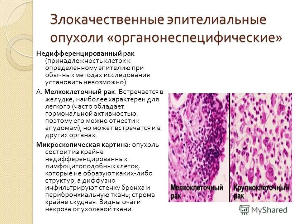железистый эпителий гистология строение. аденокарцинома эпителиальная. рак эпителиальной ткани. доброкачественная опухоль эпителиальной ткани. рак эпителиальной ткани.