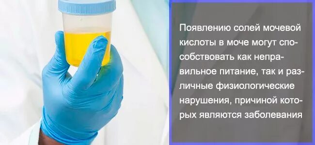 Моча это кислота. Мочевая кислота в моче. мочевая кислота в моче норма. соли мочевой кислоты в моче. кристаллы мочевой кислоты в моче.