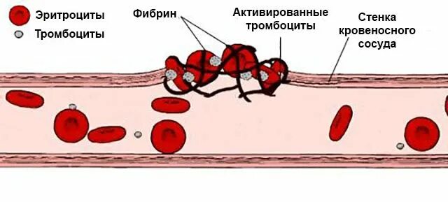 Тромб в кровеносном сосуде. Тромбоциты образование тромба. Ретракция кровяного сгустка. Образование тромбоцитарного тромба. Тромб нити