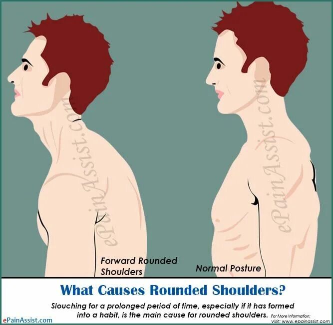 Round shouldered