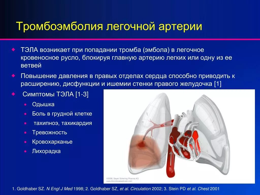 Тромб в желудочке