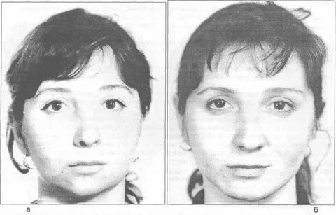 Недоразвитие челюсти