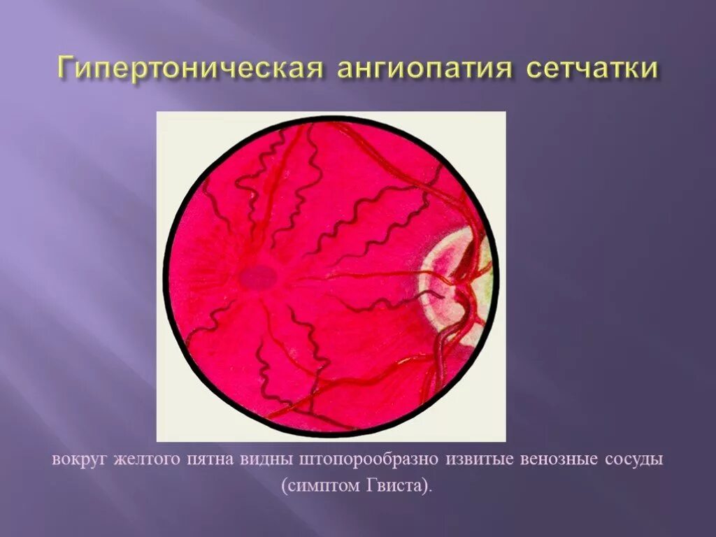 Ангиопатия сосудов глазного дна. Гипертоническая ретинопатия симптом Гвиста. Глазная болезнь ангиопатия. Гипертоническая ангиопатия глазное дно.