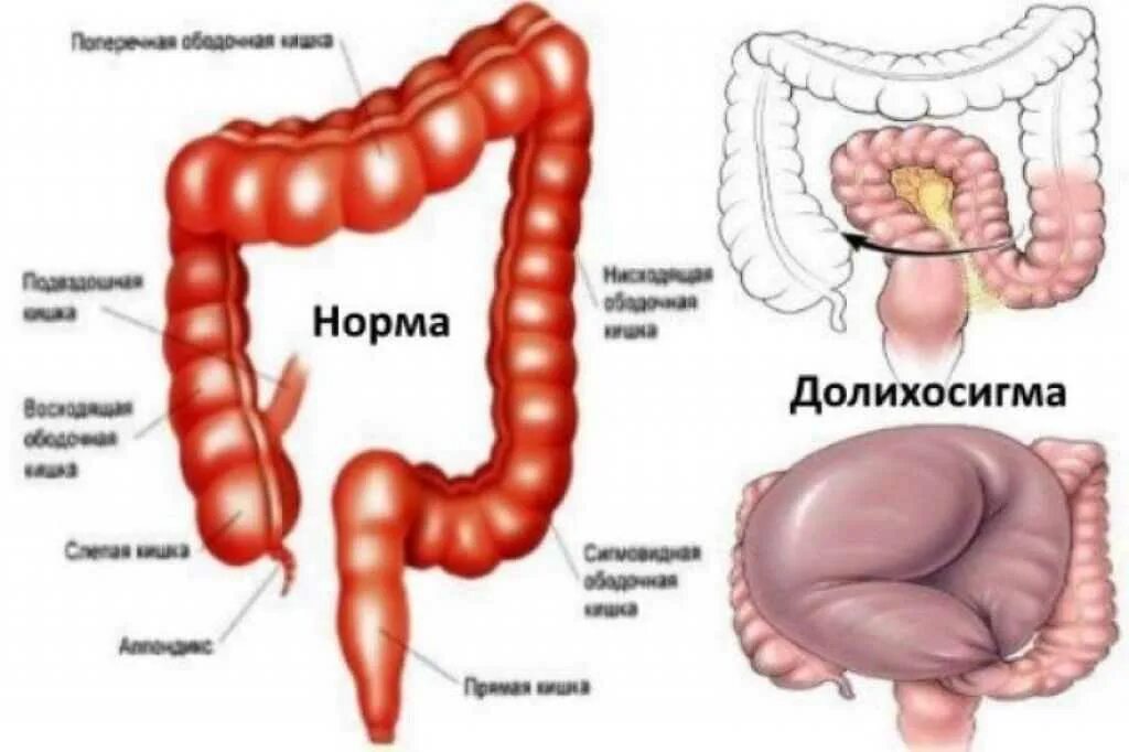 Дополнительная петля сигмовидной кишки. Сигмовидная кишка долихосигма кишечника. Удлинение сигмовидной кишки. Удлиненная сигмовидная кишка долихосигма. Удлиненная сигмовидная