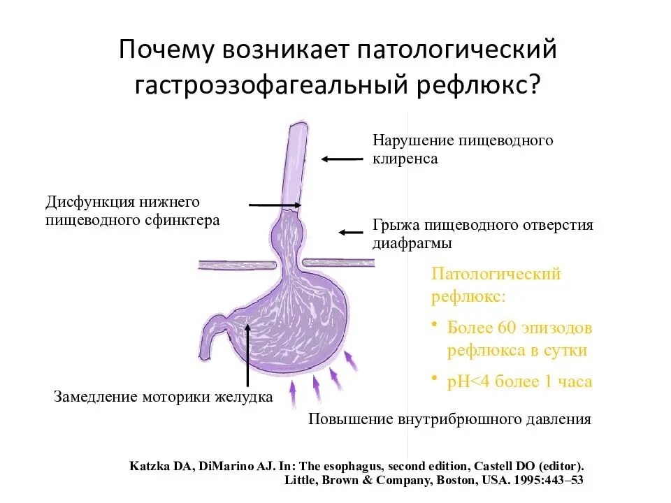 Гастроэзофагеальная рефлюкс-болезнь. Гастроэзофагеальный (желудочно-пищеводный) рефлюкс. Желудочно-пищеводный рефлюкс проявляется симптомами. Патологические механизмы желудочно-пищеводного рефлюкса.