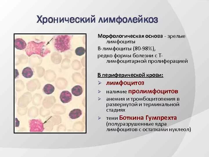 В -лимфоциты хронический лимфолейкоз. Острый лейкоз и хронический лимфолейкоз. Хронические лейкозы миелолейкоз лимфолейкоз. Тени Боткина Гумпрехта.