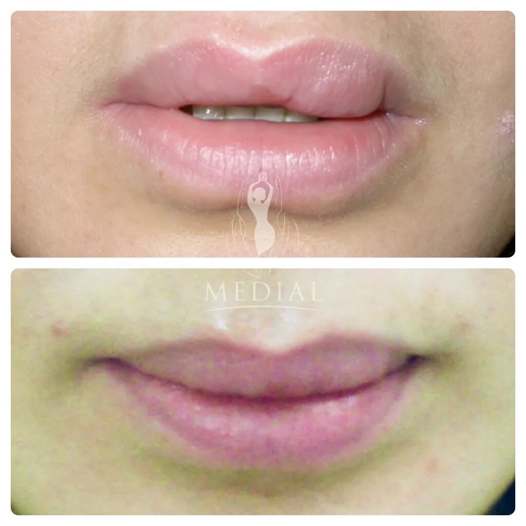 Через сколько рассасываются губы. Биополимерный гель ps350. Биополимерный гель в губах.