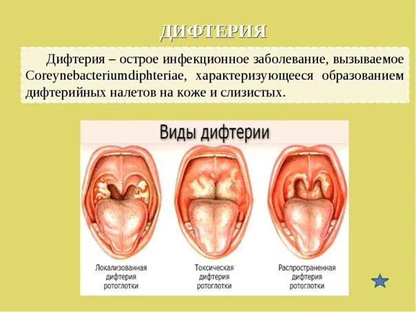 diphtheria ASL - YouTube