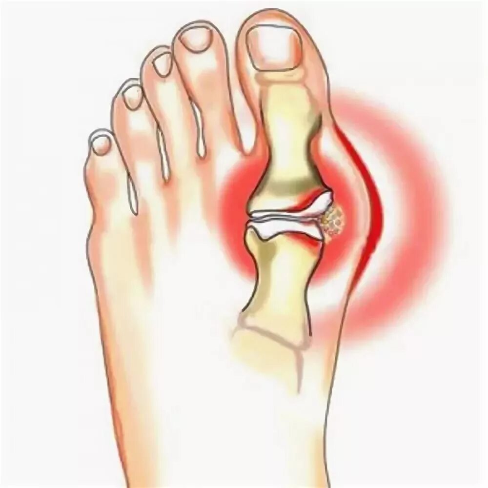 Почему болят суставы больших пальцев. Подагра воспаление суставов. Подагрический артрит большого пальца ноги.