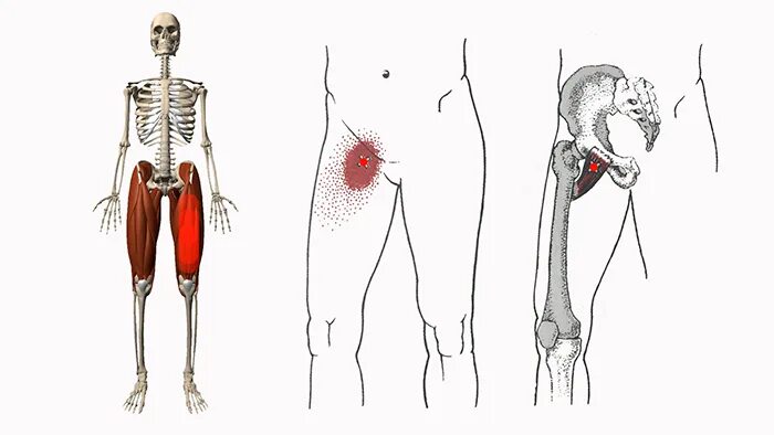 Гребенчатая мышца триггерные точки. Триггерные точки портняжная мышца. Малая ягодичная триггерные точки.