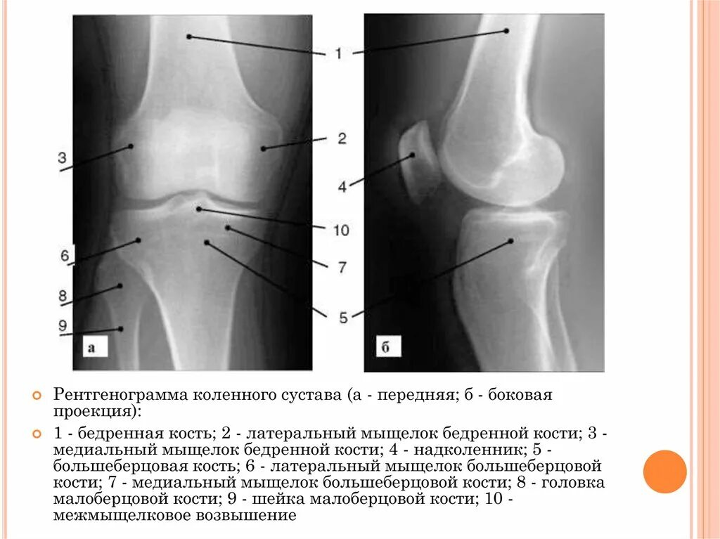 Суставной мыщелок. Рентгенограмма коленного сустава в боковой проекции. Перелом мыщелка бедренной кости. Наружный мыщелок большеберцовой кости анатомия. Коленный сустав боковая проекция.