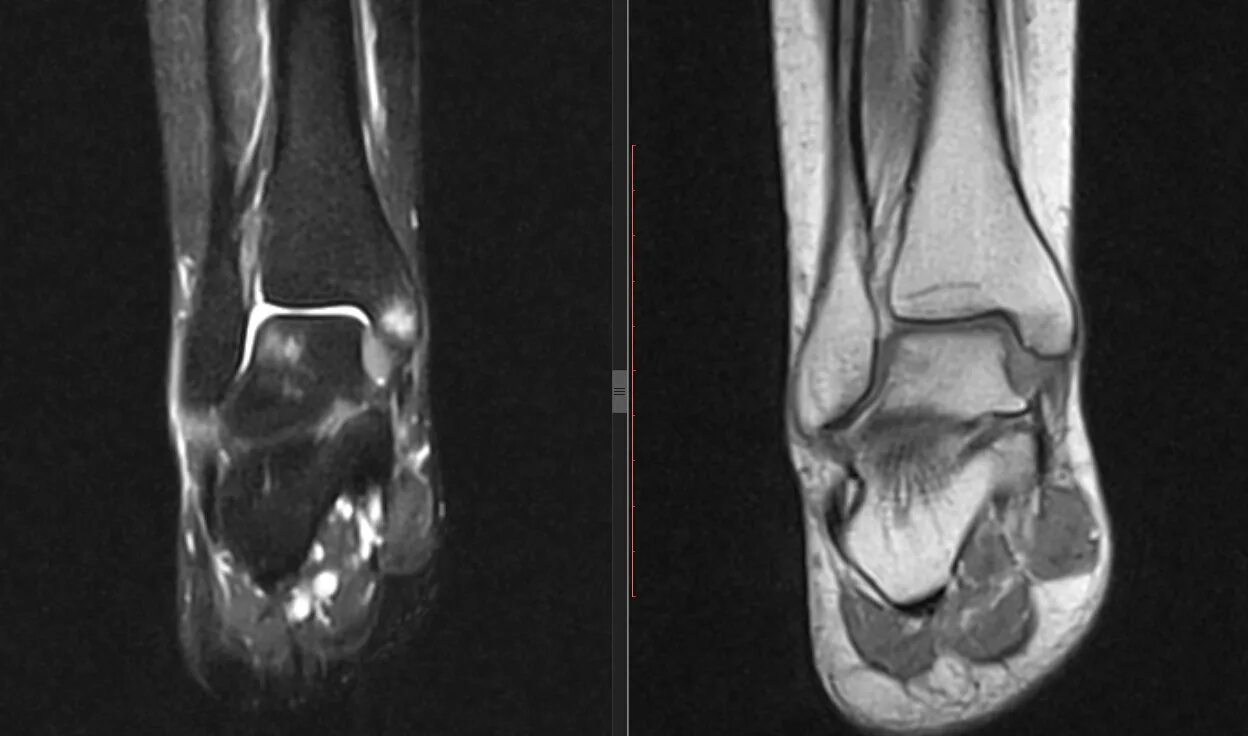 Разрыв сухожилия голеностопного сустава на мрт. Повреждение связок голеностопного сустава мрт. Анатомия голеностопного сустава мрт. Артрит голеностопного сустава мрт. Контузионные изменения кости